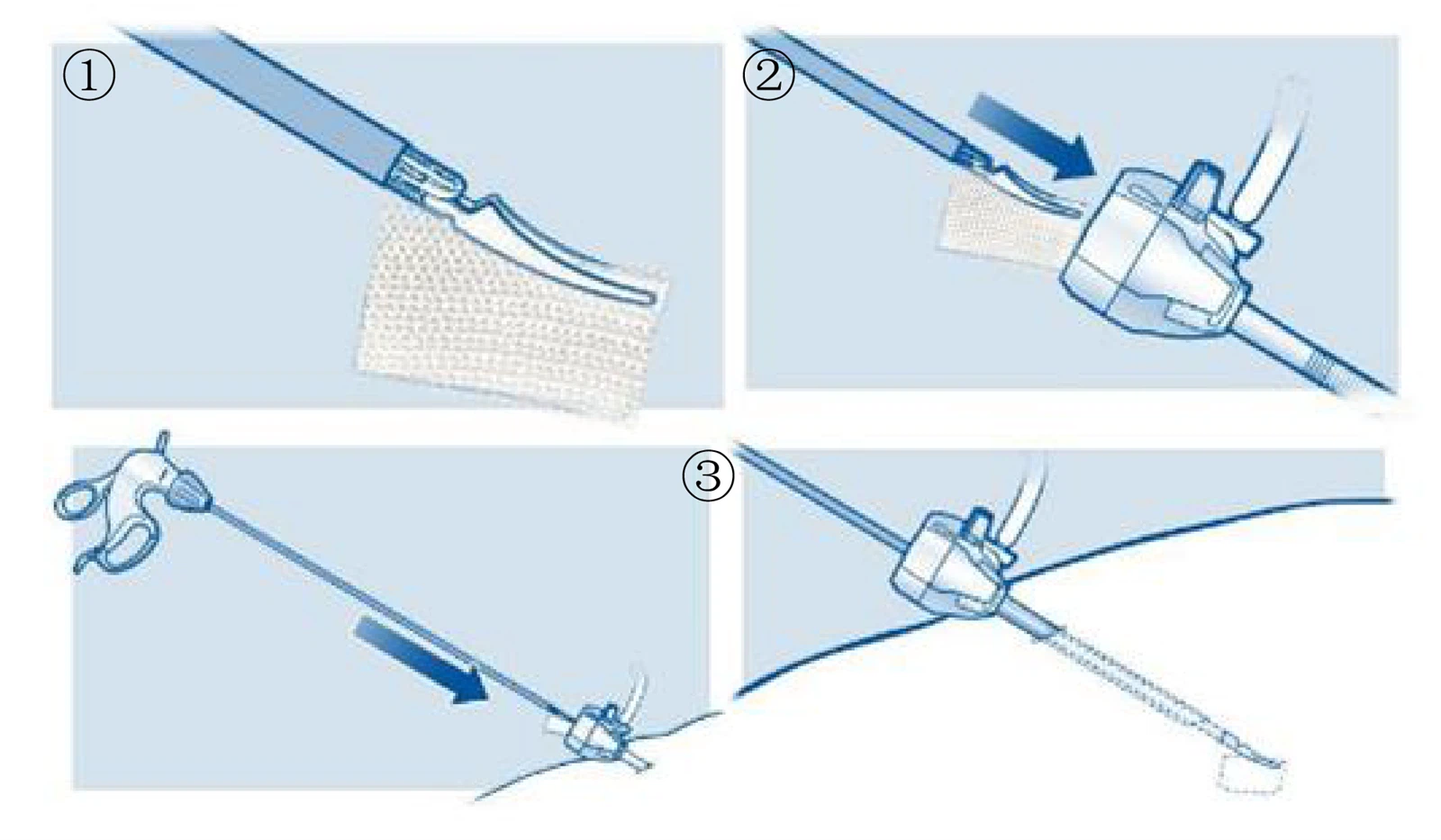 blood-stop-gauze blood-stop-gauze